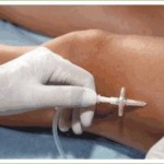 carboxiterapia