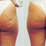 carboxiterapia 9