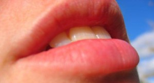 Herpes Labial – Como evitar