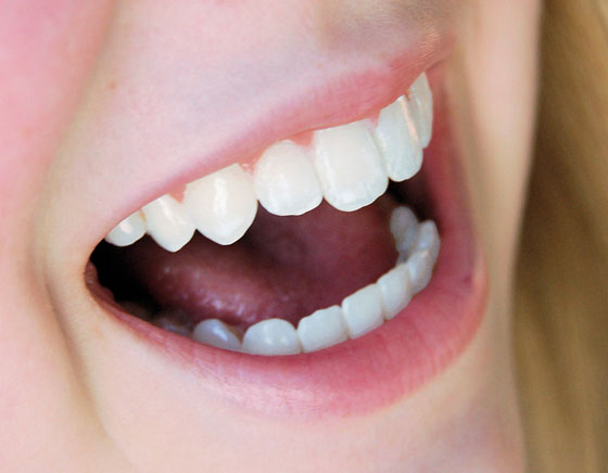 Clareamento Dental – Dicas e Tratamento